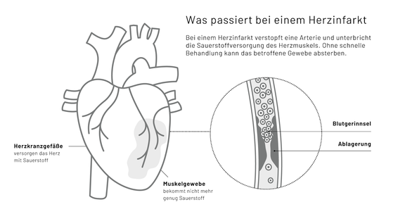 Grafik Herzinfarkt, Herz Lunge im Zentrum - Lungenarzt München