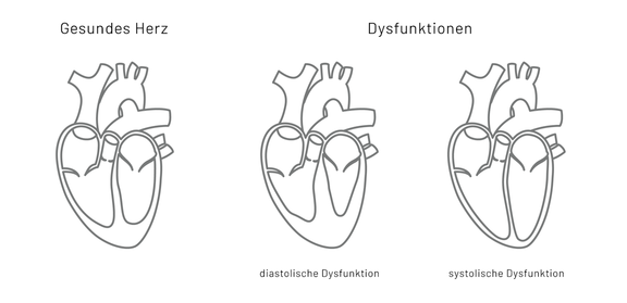 Grafik Herzinsuffizienz, Herz Lunge im Zentrum - Lungenarzt München